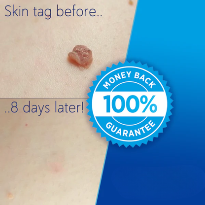 Cleariva Skin Tag Removal